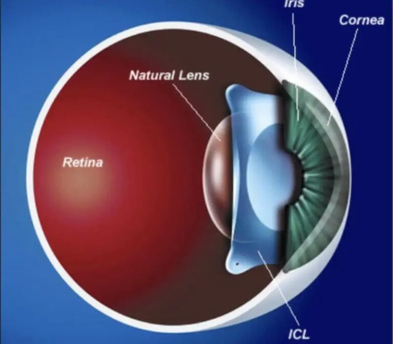 Best ICL Eye Hospital in Jalandhar