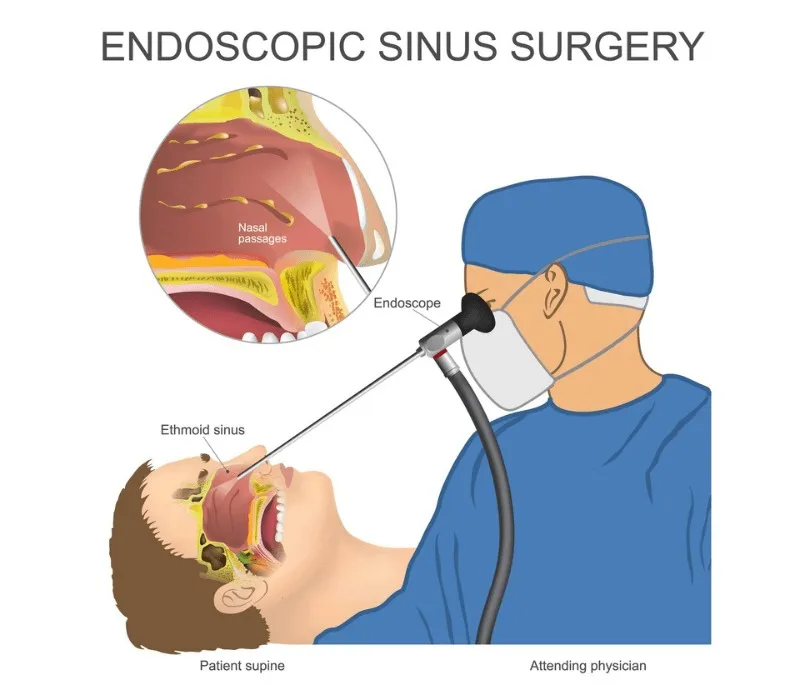 Endoscopic Sinus Surgery in Jalandhar