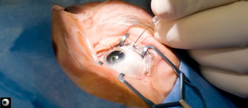 Laser Cataract Surgery at Kataria Eye and ENT Hospital